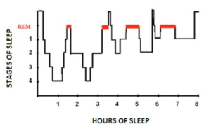 hypnogram or histogram showing sleep stages